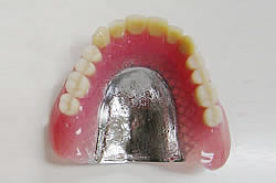 総義歯（金属床義歯）